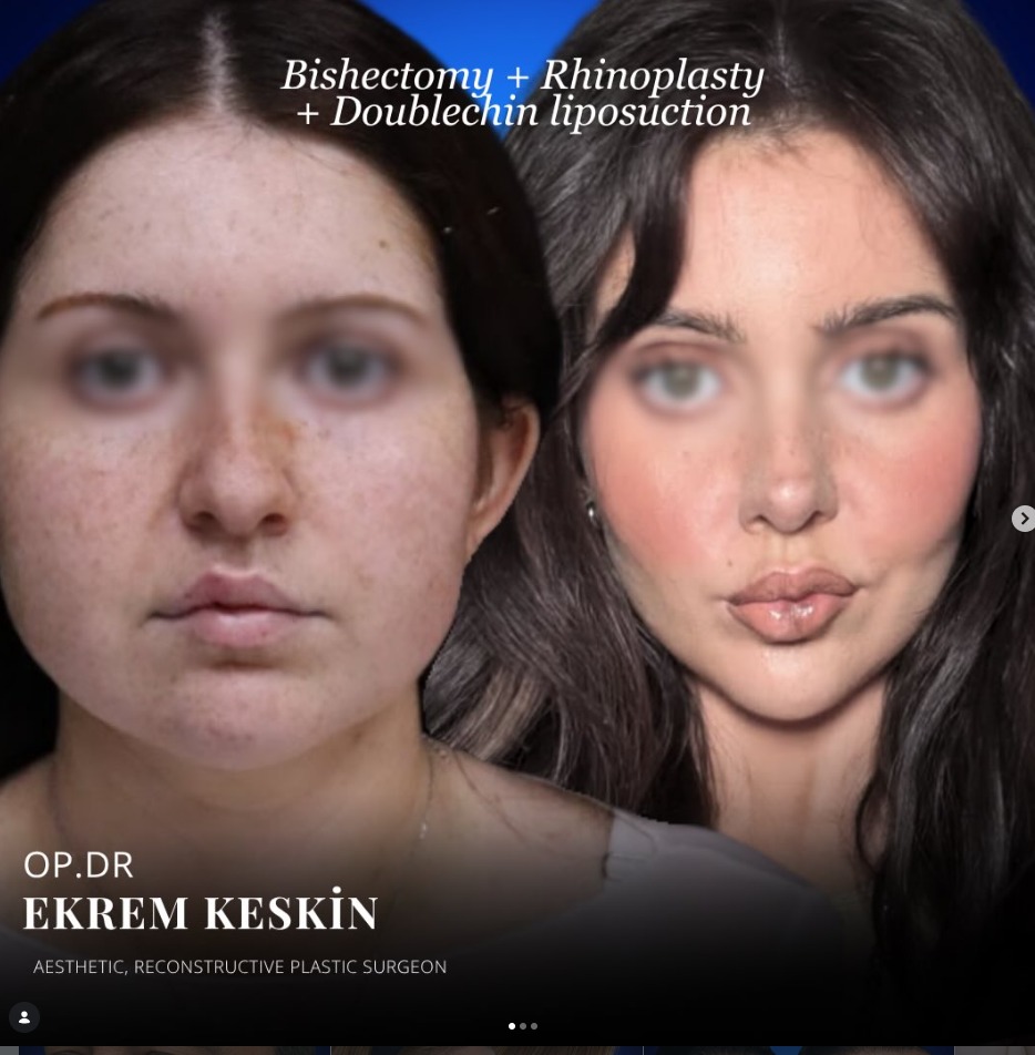 نتيجة قبل وبعد لإزالة دهون الخد وتجميل الأنف وشفط دهون الذقن المزدوج في إسطنبول، تركيا