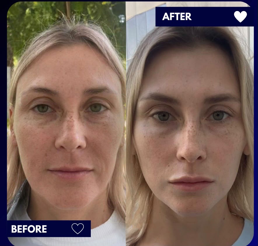 Illustrative before and after image from a deep plane facelift case in Istanbul