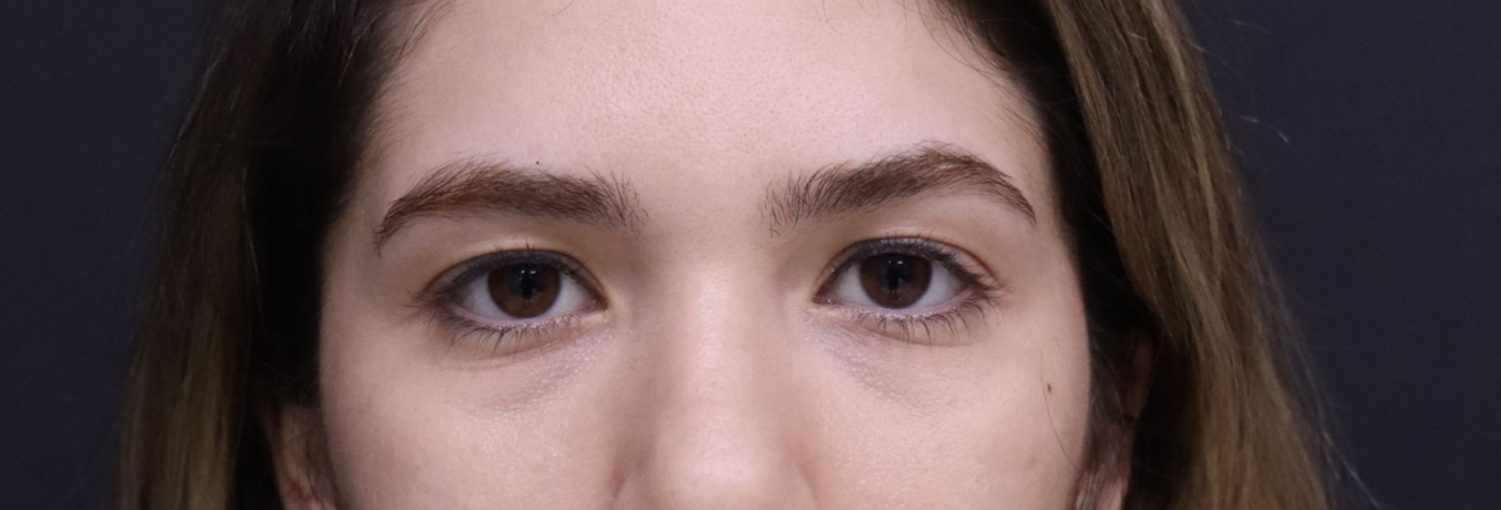 Before view in a Deep Temporal Lift case