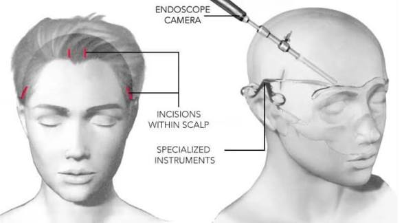 Medical illustration of endoscopic brow lift incisions within the scalp and endoscope camera insertion