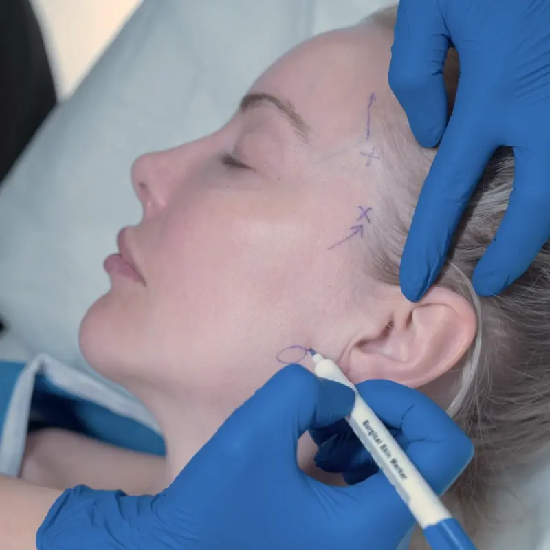 Preoperative facial markings during facelift planning