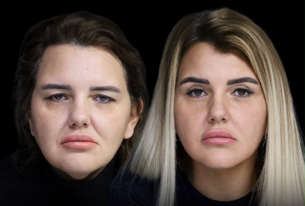 Upper eyelid surgery before and after case in Istanbul